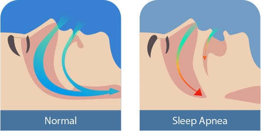 Mouth Tape For Sleeping This is Why You Need It