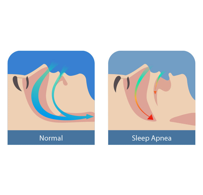 how-sleep-apnea-works-improving-sleep-arrows-guiding-explaining